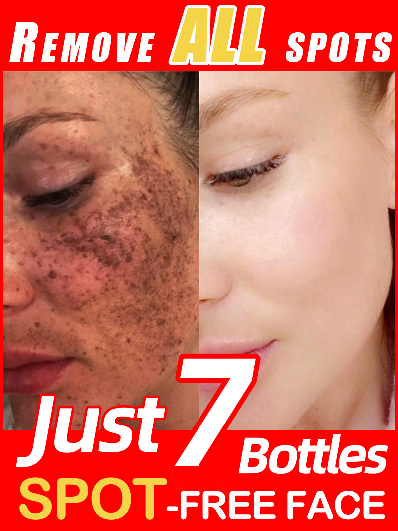 Luxury Skincare Essence - Çilleri, Melazmayı ve Yüzdeki Koyu Lekeleri